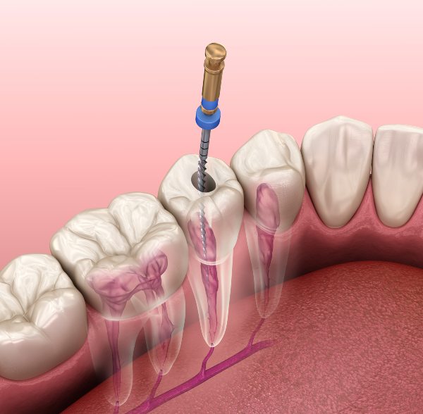 Endodoncia