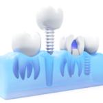 Implantes dentales inteligentes con nanopartículas y fuentes de luz